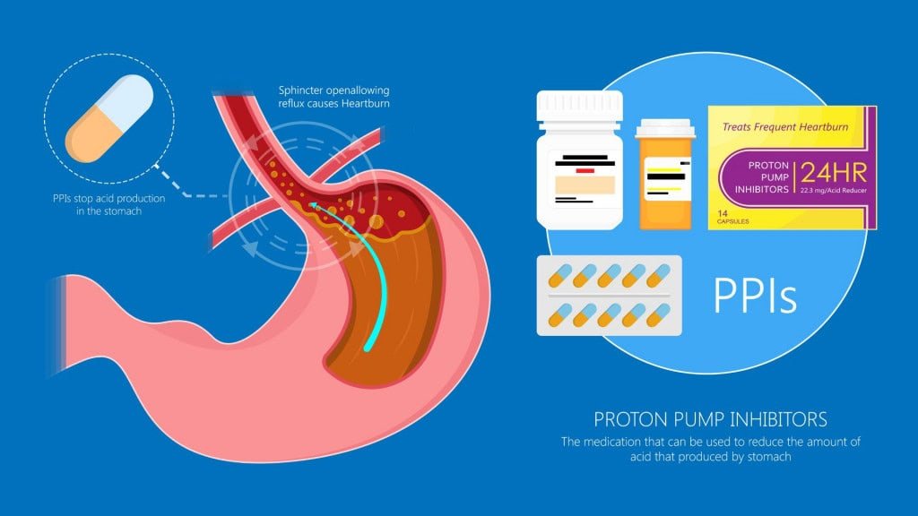 Imagem mostra o interior do corpo humano com foco no estômago e esôfago. Um tubo vermelho representa o esôfago levando alimentos ao estômago, onde há líquido amarelado (ácido). Uma válvula defeituosa permite que esse ácido suba, causando queimação. Ao lado, aparecem remédios em cápsulas e caixas que tratam esse problema, chamados inibidores da bomba de prótons.