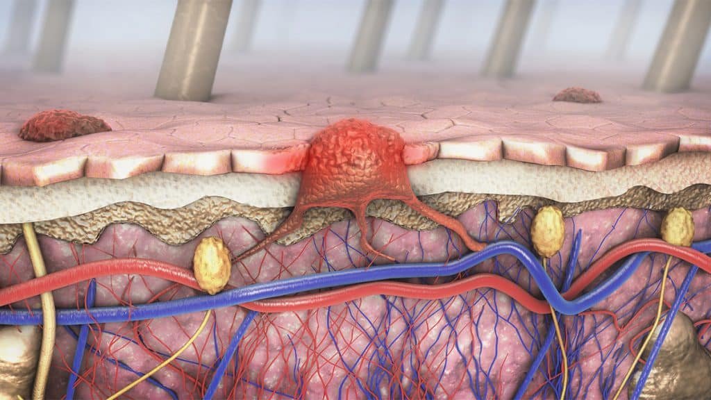 Ilustração digital de melanoma, tipo de câncer de pele