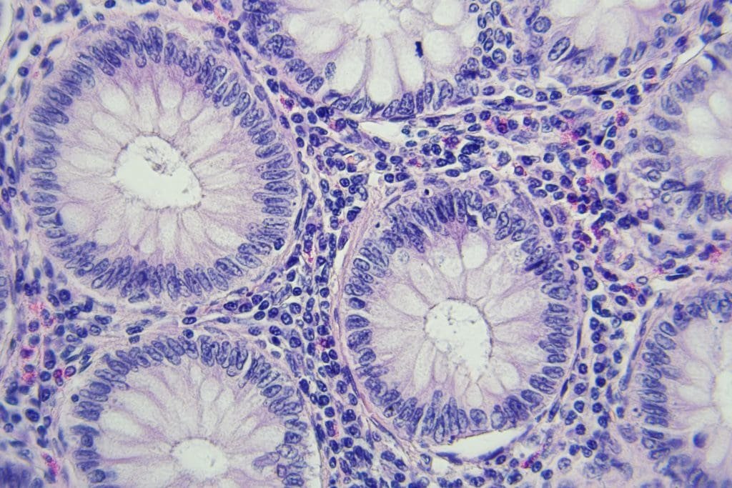Células de câncer de cólon vista no microscópio